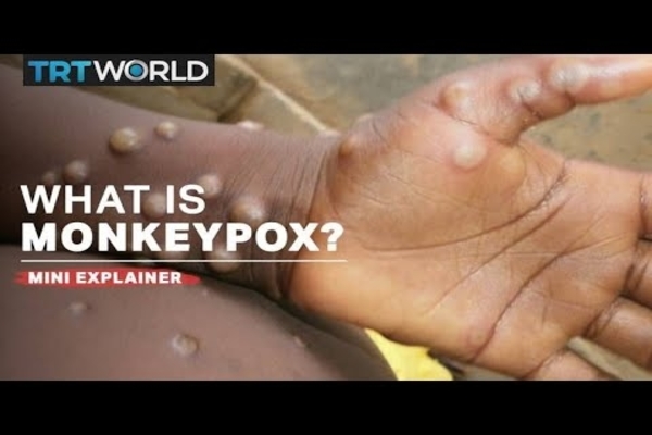 WARNING: W.H.O. Joins Chorus Warning About Monkeypox as Belgium Confirms…